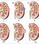 Image result for Cystic Lesion Kidney