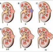 Image result for Burst Kidney Cyst