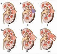 Image result for Kidney Cyst Size