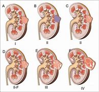 Image result for Exophytic Cyst Kidney
