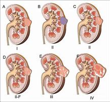 Image result for Cyst On the Kidney