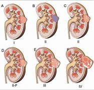 Image result for Exophytic Lesion Kidney