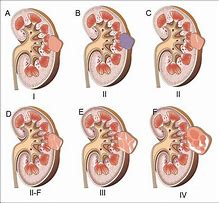 Image result for Mass On Left Kidney