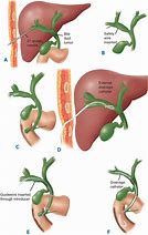 Image result for External Biliary Drain