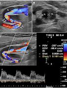 Image result for FMD Carotid Ultrasound