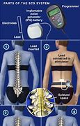 Image result for Other Implant Devices for Humans
