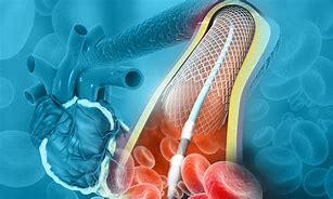 Image result for Angioplasty