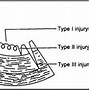 Image result for Acute Coronary Syndrome Plaque Rupture