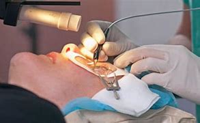 Image result for Lasik Surgery Procedure