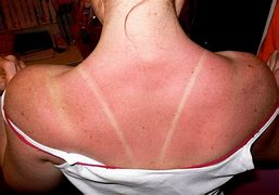 Image result for severe sunburn symptoms