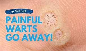 Image result for Wart Treatment Amiqualid