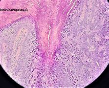 Image result for Verruca Vulgaris Pathology