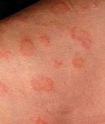 Image result for Common Fungal Skin Diseases