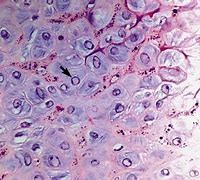 Image result for Viral Papilloma