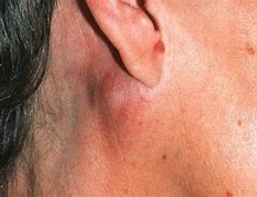 Image result for Cancerous Lumps On Head