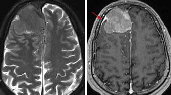 Image result for Meningioma Brain MRI
