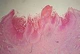 Image result for Pediatric Molluscum Contagiosum