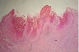 Image result for Molluscum Contagiosum On Black Skin