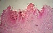 Image result for Molluscum Bodies Histology