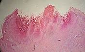Image result for Molluscum Contagiosum Scarring