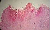 Image result for Molluscum Bodies