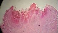 Image result for Molluscum Contagiosum Children