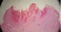 Image result for Molluscum Lesions
