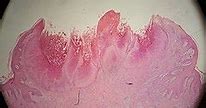 Image result for Skin Rash Molluscum Contagiosum