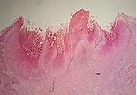 Image result for Getting Rid of Molluscum Contagiosum