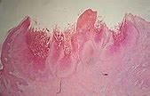 Image result for Molluscum Contagiosum Rash