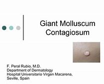 Image result for Giant Molluscum Contagiosum