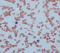 Image result for Heterozygous Sickle Cell Disease