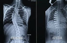 Image result for Back Brace for Curvature of the Spine