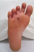 Image result for Foot Wound Measurement