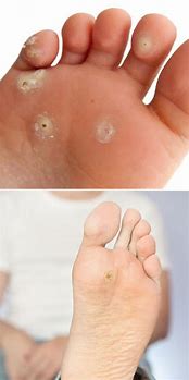 Image result for Papilloma On Foot