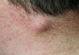 Image result for Occipital Area Sebacious Cyst