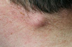 Image result for Sebaceous Cyst Neck