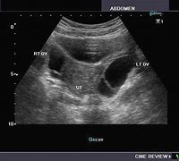 Image result for Enlarged Ovary Ultrasound