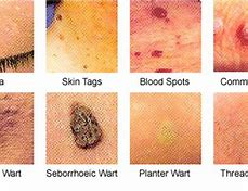 Image result for All the Various Types of Warts