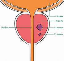 Image result for How Big Is 9Mm Tumor