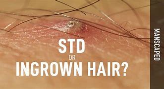 Image result for STD vs Ingrown Hair