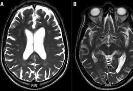 Image result for T2 Axial Blade Lesions On Brain MRI