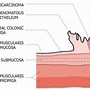 Image result for Annular Lesion Colon