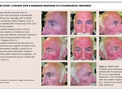Image result for Actinic Keratosis Cream