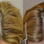 Image result for Female Hair Loss Before and After