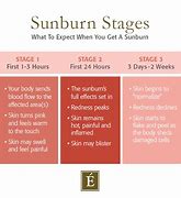 Image result for Stages of SunBurn