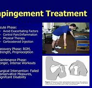 Image result for Shoulder Impingement Syndrome Treatment