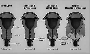 Image result for Cervical Cancer Staging
