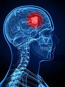 Image result for Brain Tumor Signs