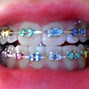 Image result for Braces Bands Colours